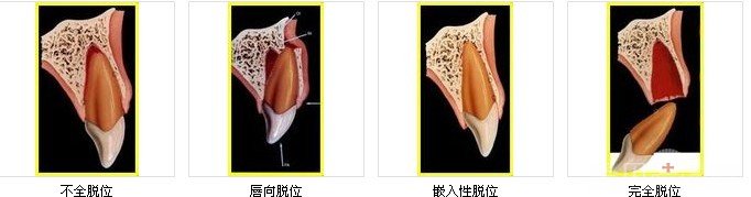 完全牙脱位该如何复位