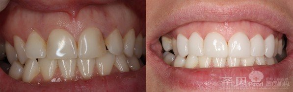 做一次牙齿美白能保持多久