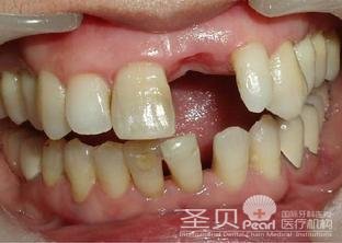 种植牙 种植        门牙缺失比较直接的影响就是影响个人牙齿的美观.
