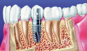 种植牙什么材料比较好