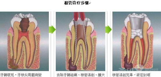 根管治疗——根除牙痛比较彻底比较佳方法