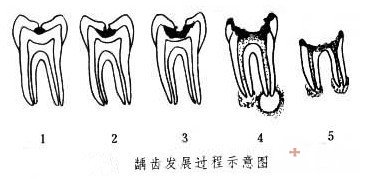 有蛀牙怎么办