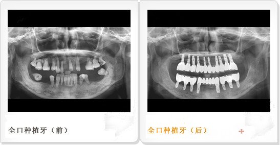 全口牙缺失治疗前后对比