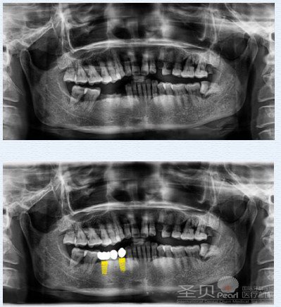 三颗牙缺失 牙齿种植修复案例