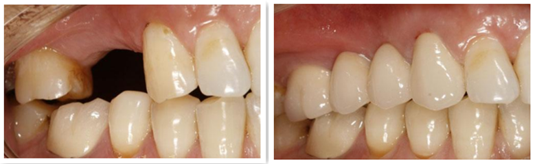 牙齿缺损种植案例
