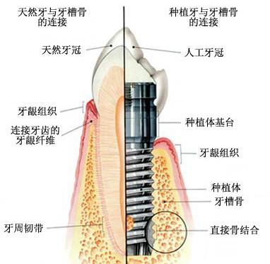 什么是种植牙