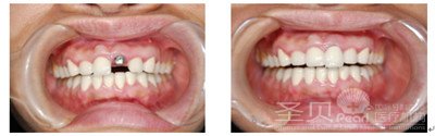 门牙缺失 种植牙弥补你的遗憾