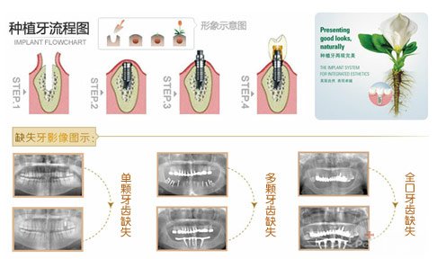 种植牙后会感觉到痛吗