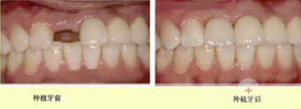 微痛种植牙有哪些优点