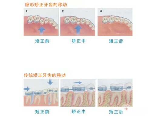 隐形牙齿矫正带牙套有效吗