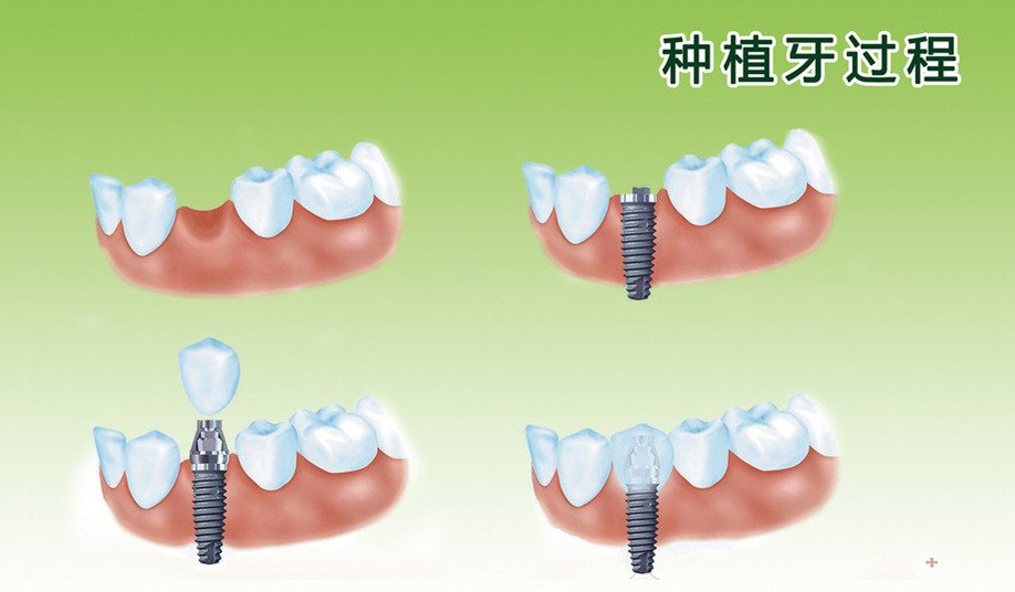 为什么种植牙价格会比普通假牙贵呢