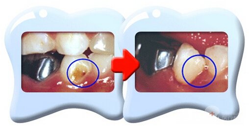 龋齿怎么治疗比较好
