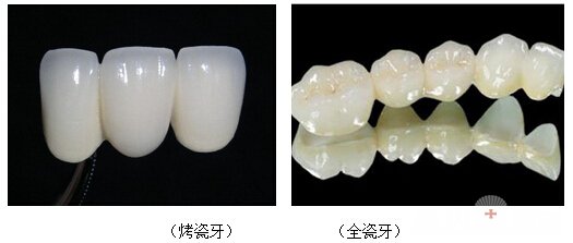 烤瓷牙和全瓷牙的区别