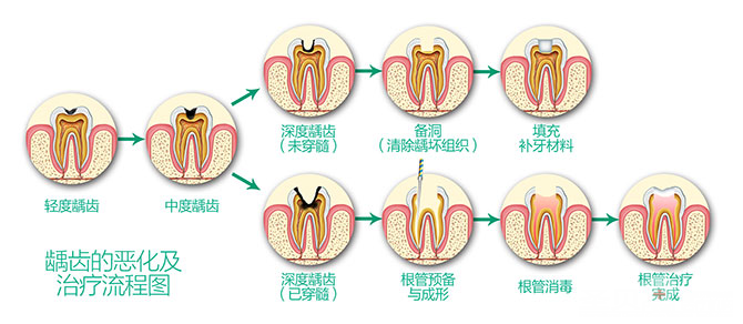 蛀牙要怎么治疗