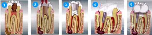 根管治疗的过程