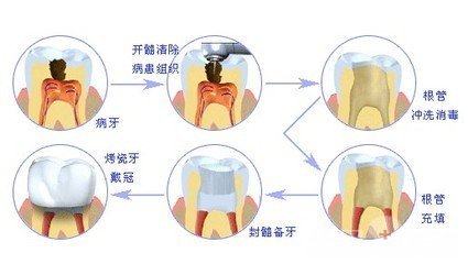  龋齿是拔还是补好