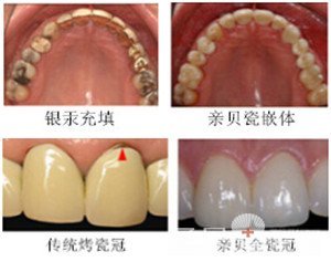 为您解析 烤瓷牙多少钱一颗3