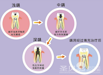 成都虫牙该怎么修复3