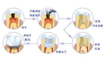 牙齿根管治疗多少钱2