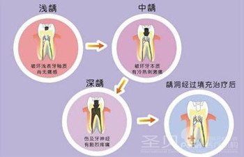 蛀牙全攻略——技术篇2